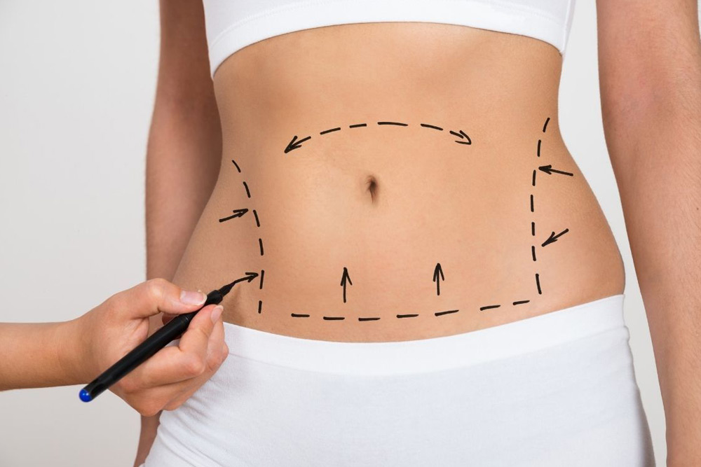 abdominoplastia-cirugia-be-fabulous-madrid-centro-medico-estetico1