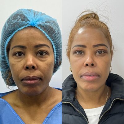 blefaroplastria completa Madrid