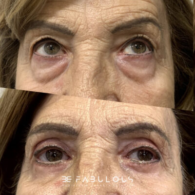 blefaroplastria completa Madrid