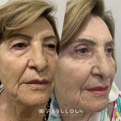 blefaroplastria completa Madrid
