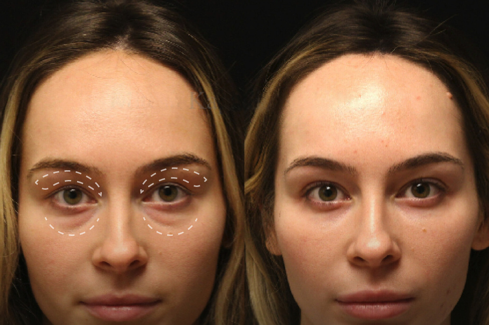 blefaroplastia-facial-be-fabulous-madrid2